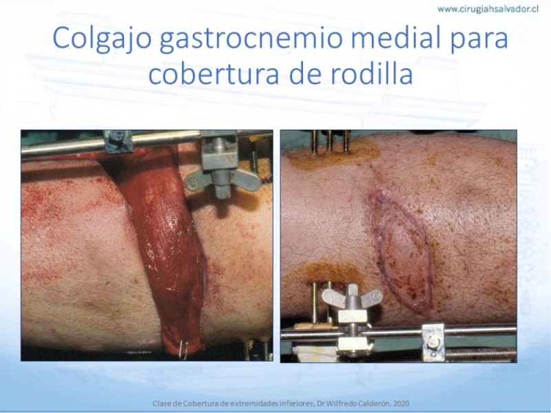 Diapositiva 34 de Cobertura de Extremidades Inferiores