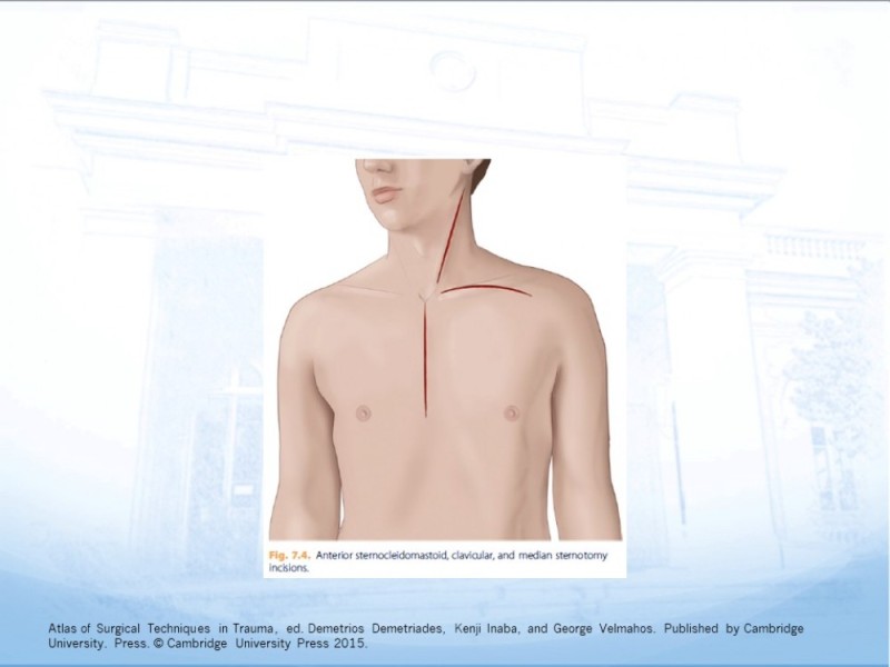 Diapositiva 42 de Trauma Cervical