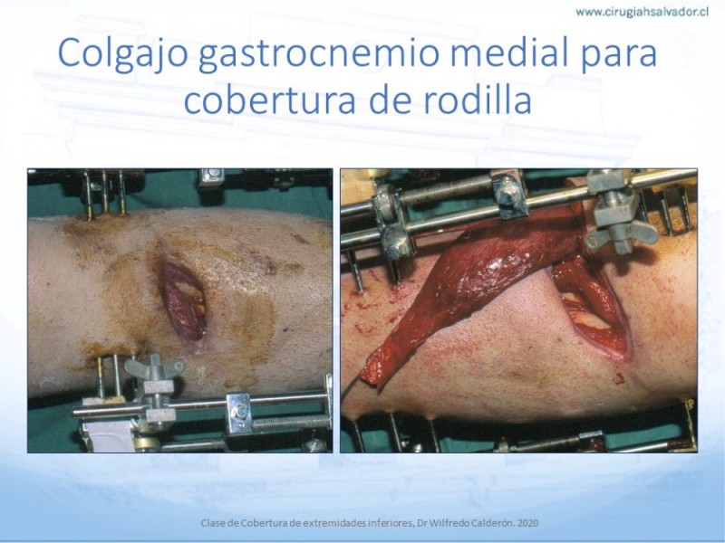 Diapositiva 33 de Cobertura de Extremidades Inferiores