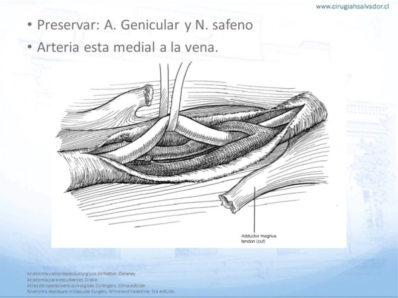 Diapositiva 23 de Anatomía quirúrgica y accesos quirúrgicos femoral y poplíteo