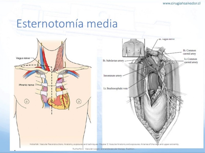 Diapositiva 23 de Anatomía quirúrgica y accesos quirúrgicos carotideo y subclavio