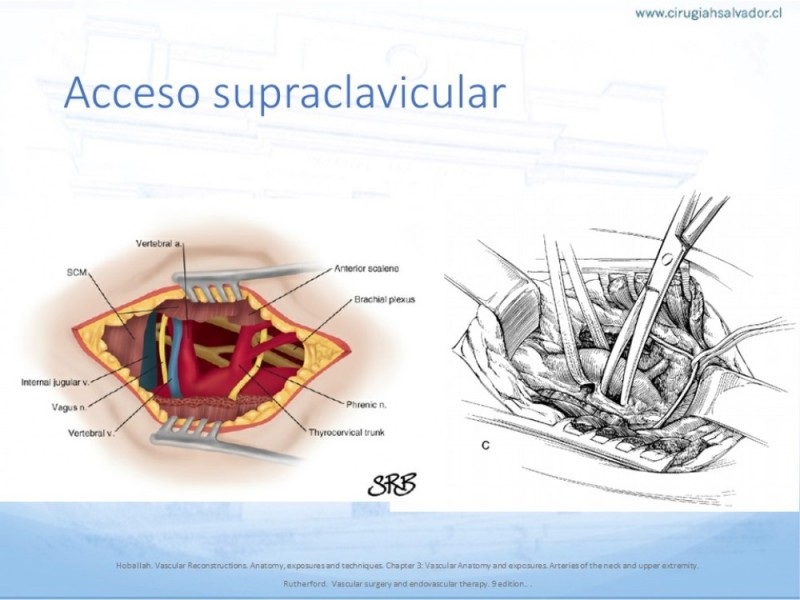 Diapositiva 21 de Anatomía quirúrgica y accesos quirúrgicos carotideo y subclavio