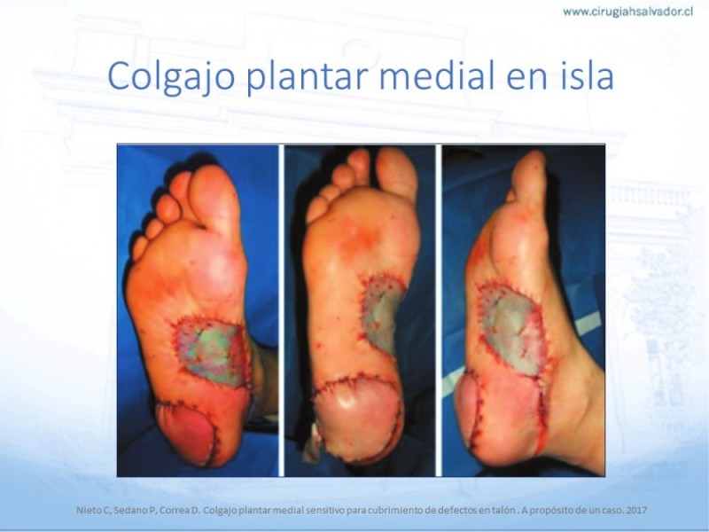 Diapositiva 57 de Cobertura de Extremidades Inferiores