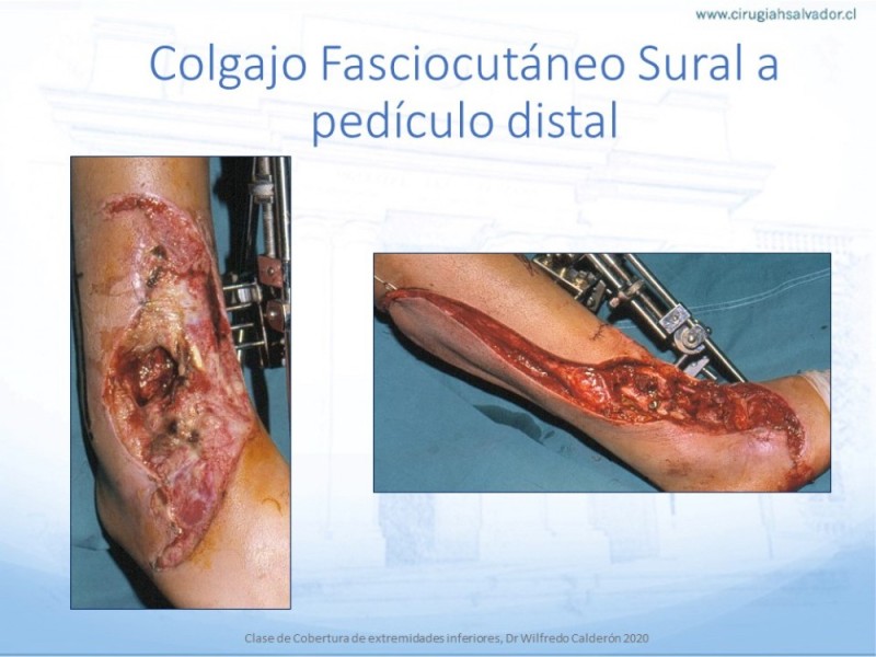 Diapositiva 46 de Cobertura de Extremidades Inferiores
