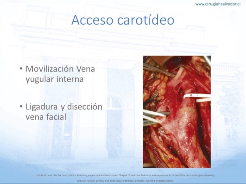 Diapositiva 12 de Anatomía quirúrgica y accesos quirúrgicos carotideo y subclavio