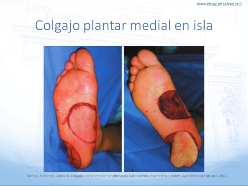 Diapositiva 56 de Cobertura de Extremidades Inferiores