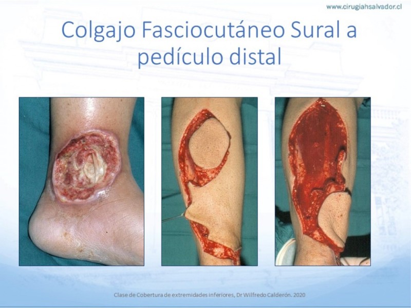 Diapositiva 48 de Cobertura de Extremidades Inferiores