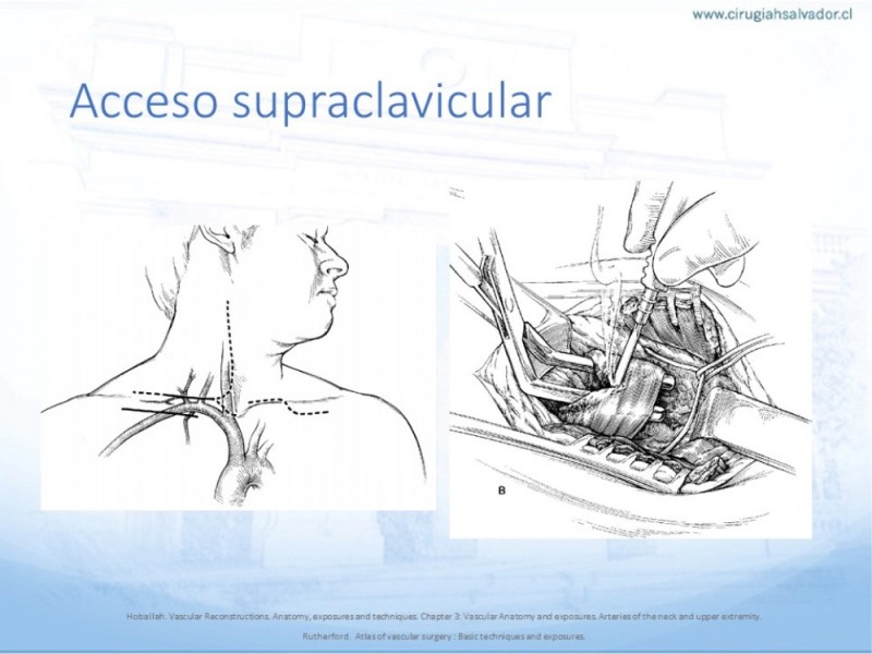 Diapositiva 20 de Anatomía quirúrgica y accesos quirúrgicos carotideo y subclavio