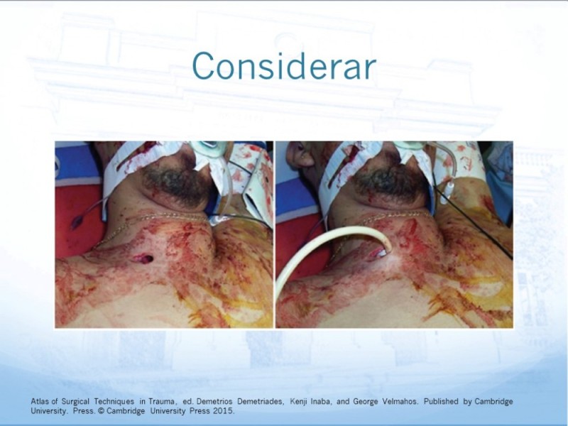 Diapositiva 22 de Trauma Cervical