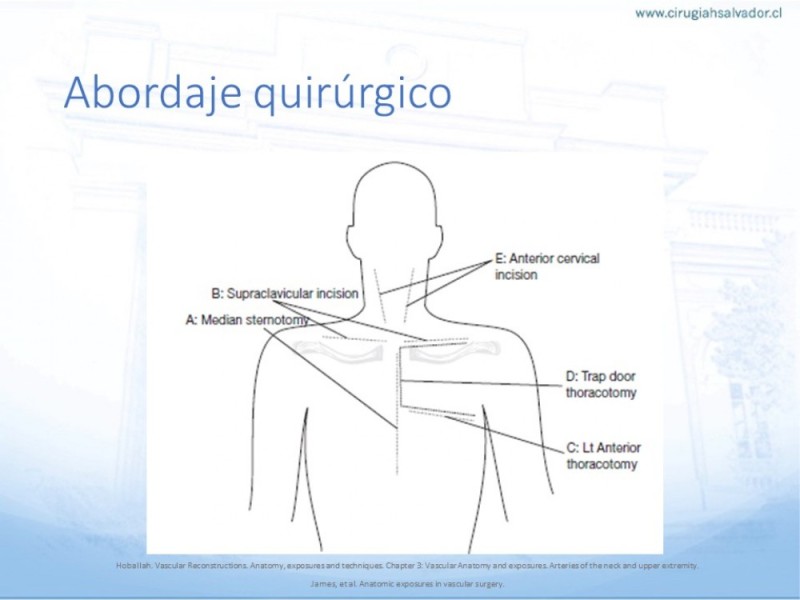 Diapositiva 18 de Anatomía quirúrgica y accesos quirúrgicos carotideo y subclavio