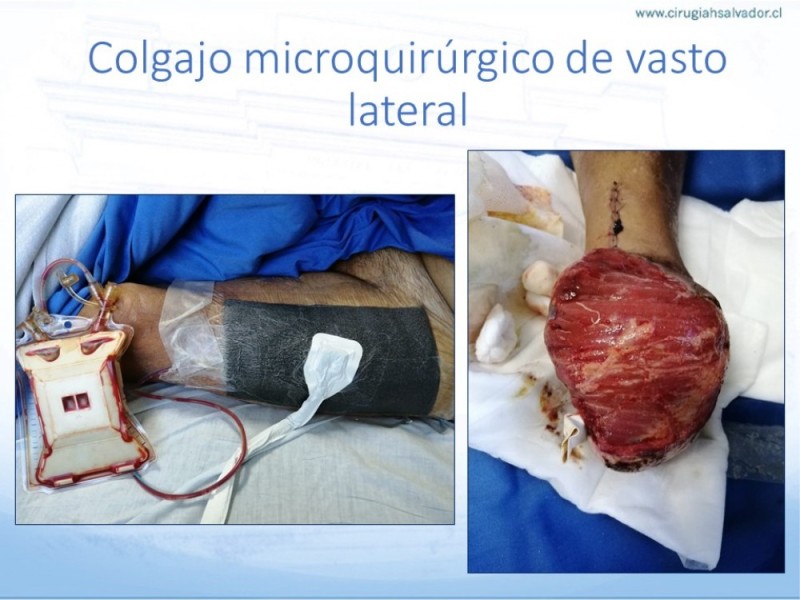 Diapositiva 63 de Cobertura de Extremidades Inferiores