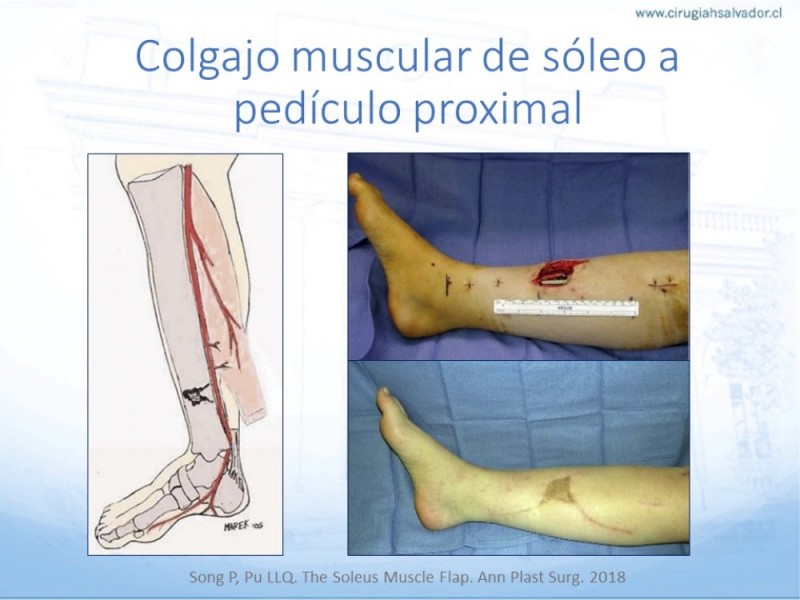 Diapositiva 40 de Cobertura de Extremidades Inferiores