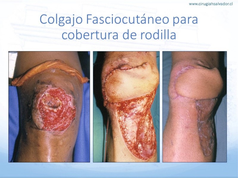 Diapositiva 32 de Cobertura de Extremidades Inferiores