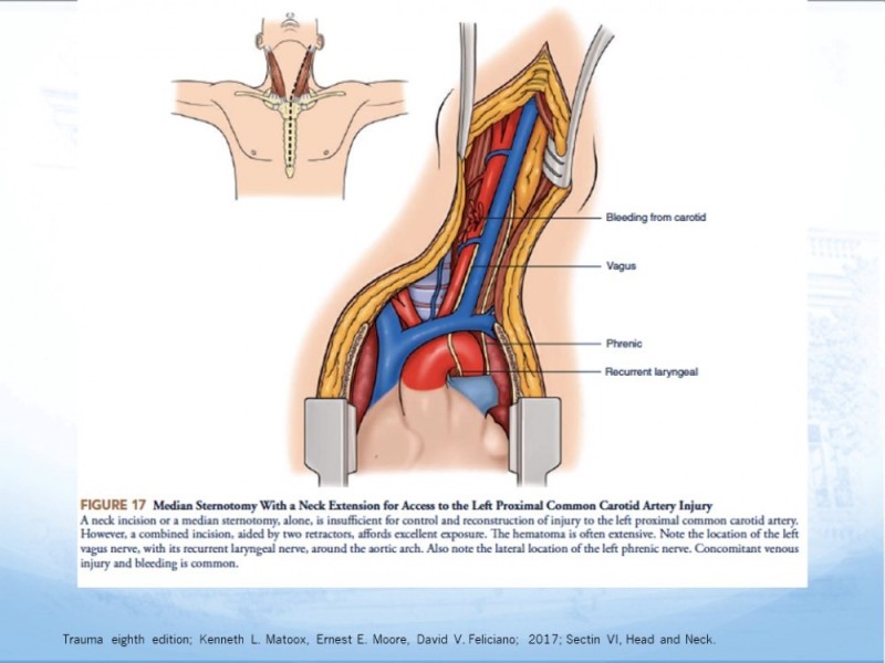 Diapositiva 44 de Trauma Cervical