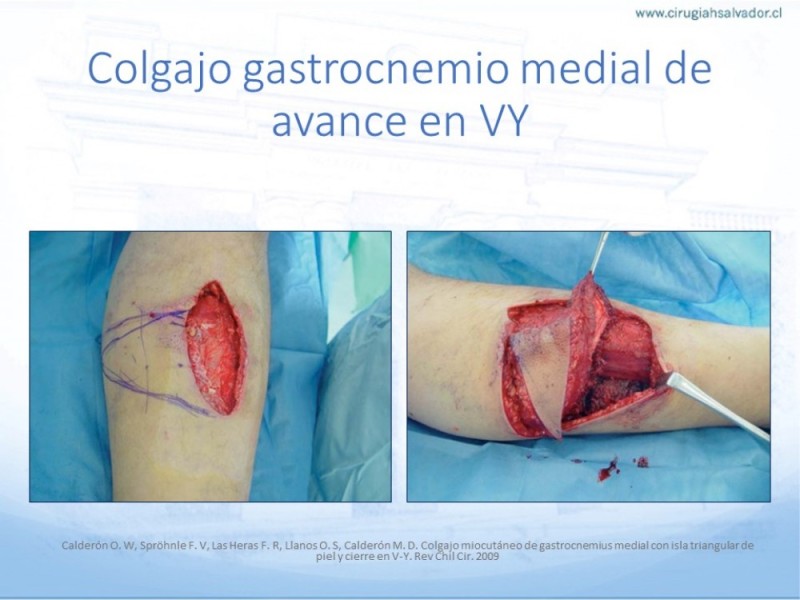 Diapositiva 38 de Cobertura de Extremidades Inferiores