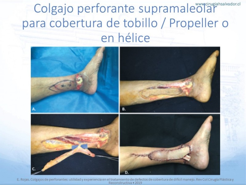 Diapositiva 51 de Cobertura de Extremidades Inferiores
