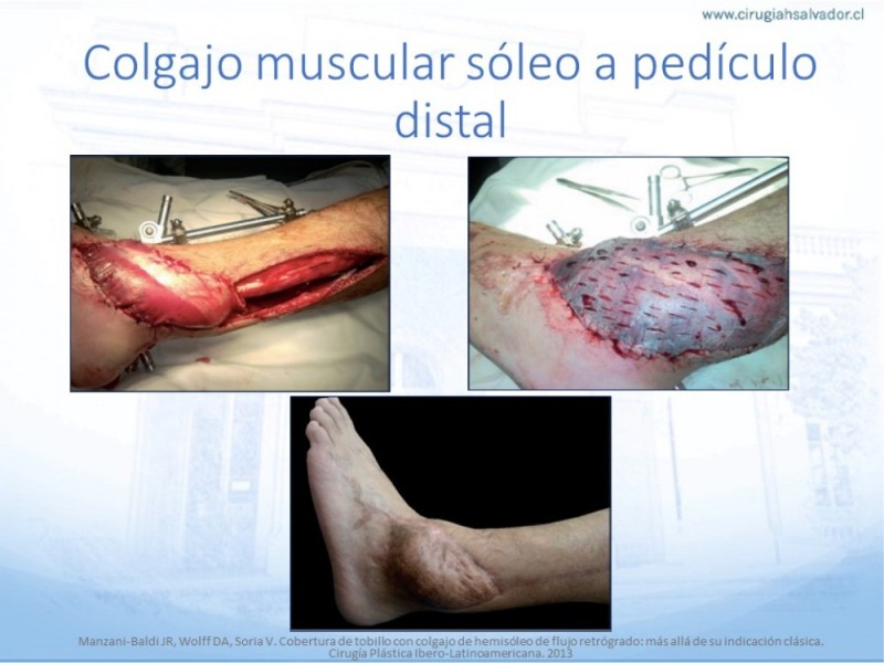 Diapositiva 44 de Cobertura de Extremidades Inferiores