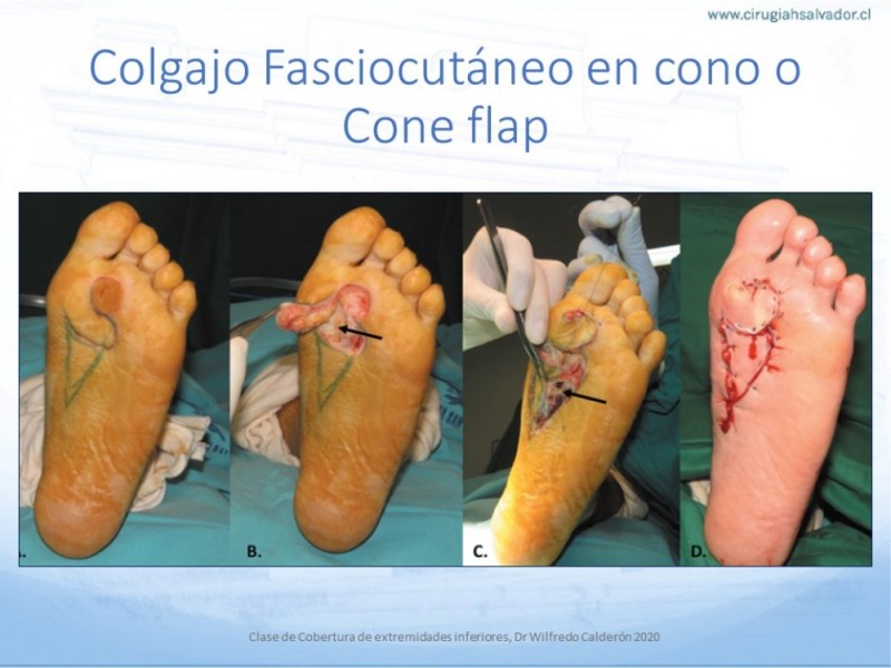 Diapositiva 58 de Cobertura de Extremidades Inferiores