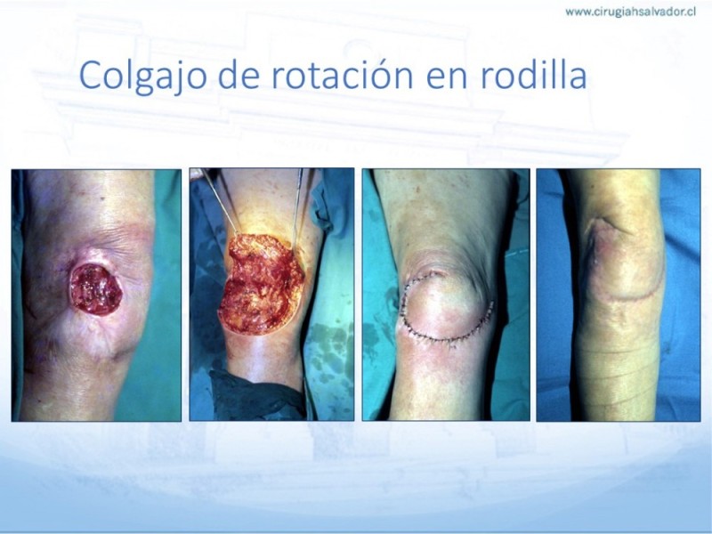 Diapositiva 31 de Cobertura de Extremidades Inferiores