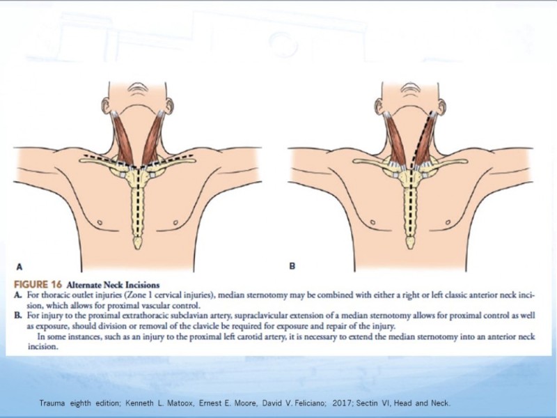 Diapositiva 43 de Trauma Cervical