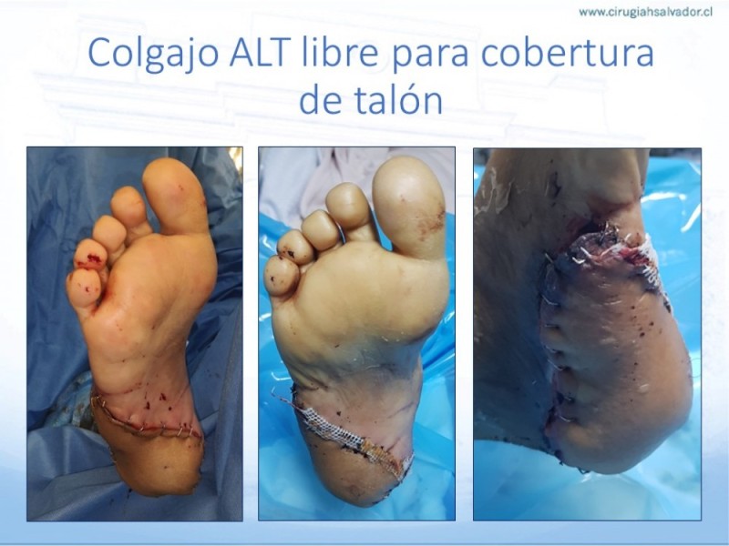 Diapositiva 53 de Cobertura de Extremidades Inferiores