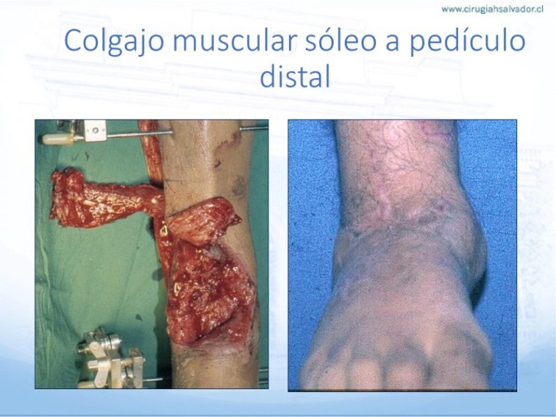 Diapositiva 45 de Cobertura de Extremidades Inferiores