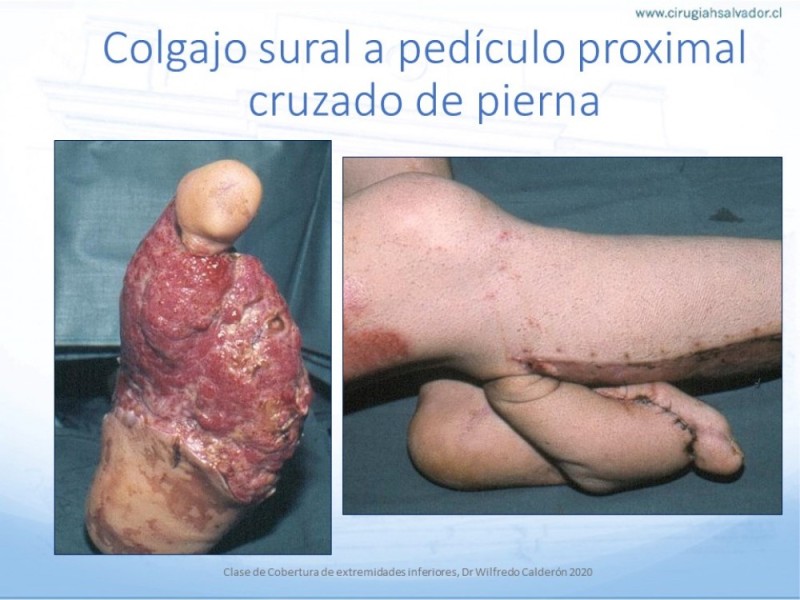 Diapositiva 60 de Cobertura de Extremidades Inferiores