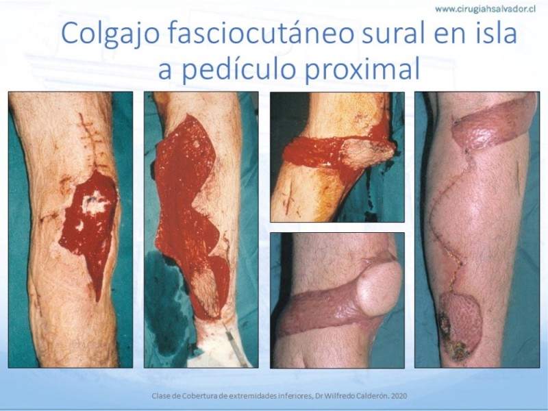 Diapositiva 35 de Cobertura de Extremidades Inferiores