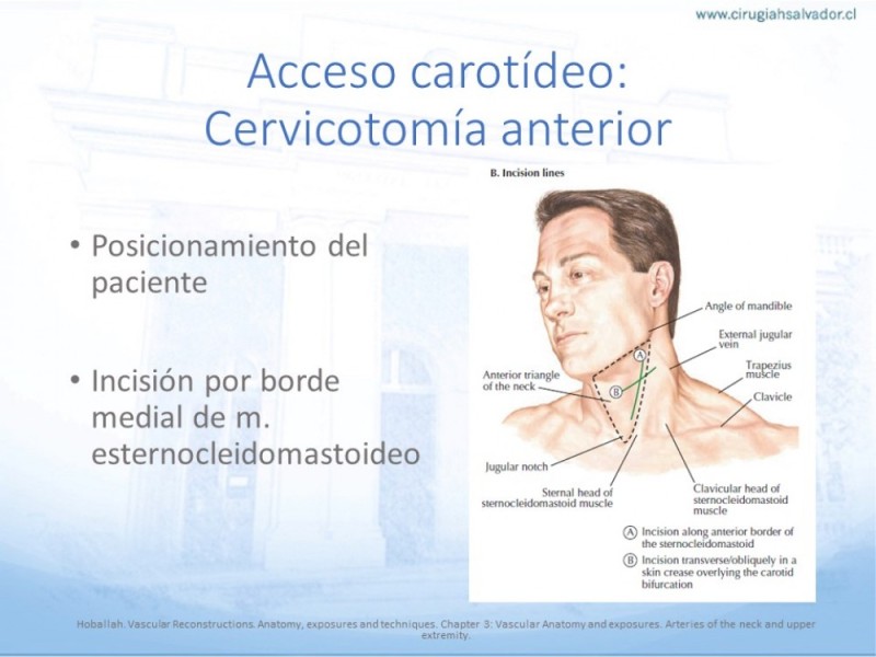 Diapositiva 8 de Anatomía quirúrgica y accesos quirúrgicos carotideo y subclavio