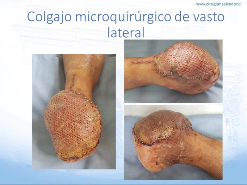 Diapositiva 64 de Cobertura de Extremidades Inferiores