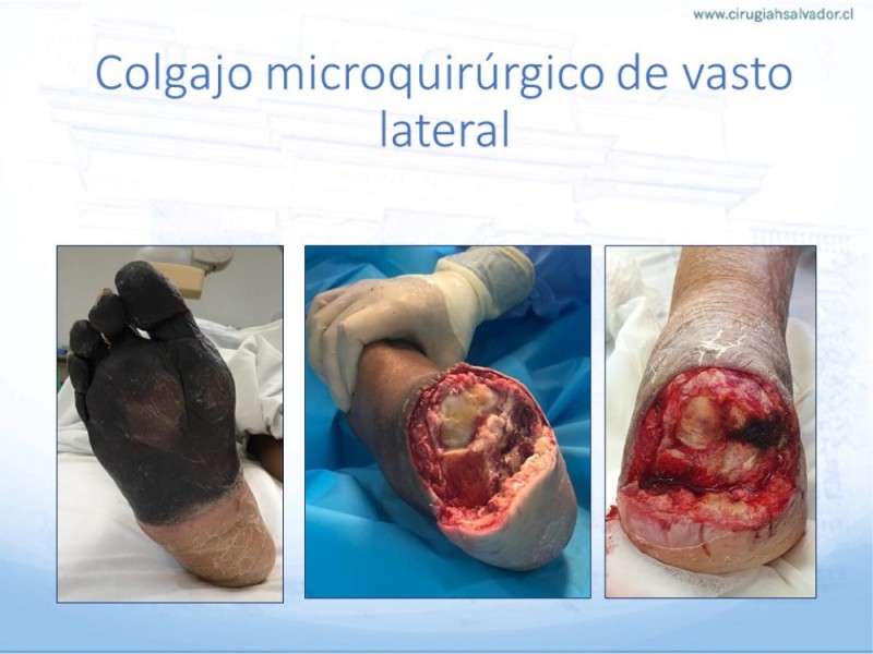 Diapositiva 62 de Cobertura de Extremidades Inferiores