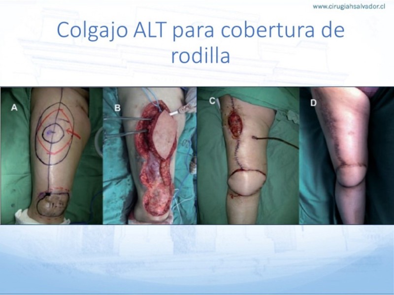 Diapositiva 30 de Cobertura de Extremidades Inferiores