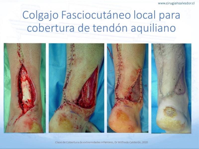 Diapositiva 50 de Cobertura de Extremidades Inferiores