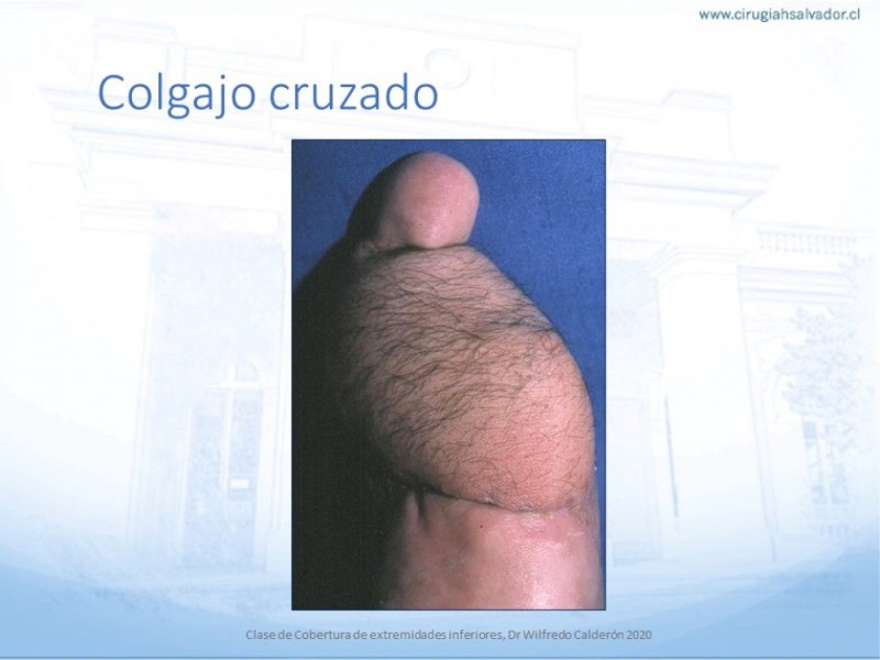 Diapositiva 61 de Cobertura de Extremidades Inferiores