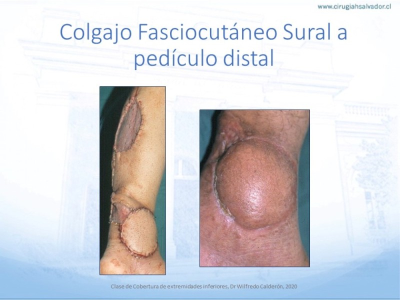 Diapositiva 49 de Cobertura de Extremidades Inferiores