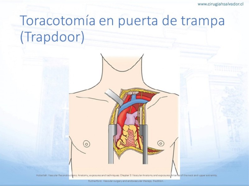 Diapositiva 25 de Anatomía quirúrgica y accesos quirúrgicos carotideo y subclavio