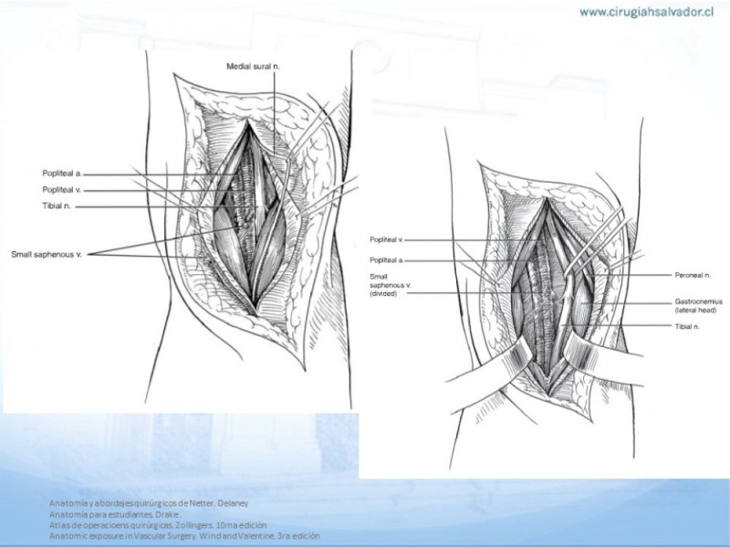 Diapositiva 19 de Anatomía quirúrgica y accesos quirúrgicos femoral y poplíteo