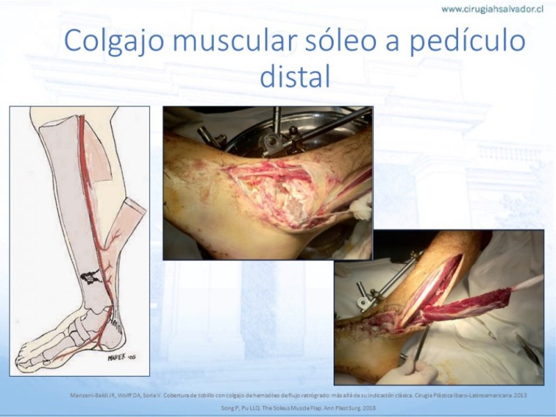 Diapositiva 43 de Cobertura de Extremidades Inferiores