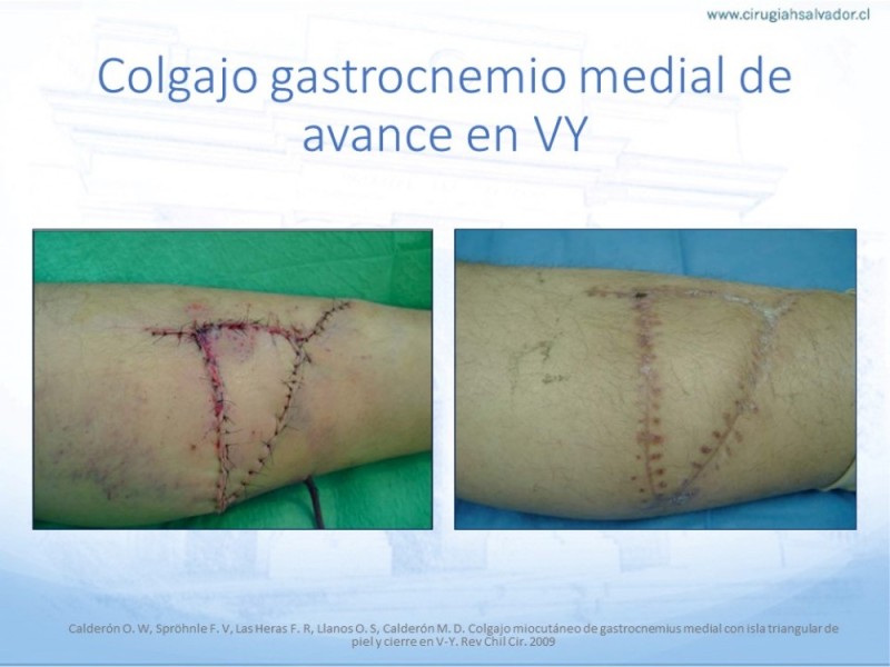 Diapositiva 39 de Cobertura de Extremidades Inferiores