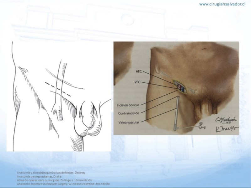Diapositiva 8 de Anatomía quirúrgica y accesos quirúrgicos femoral y poplíteo