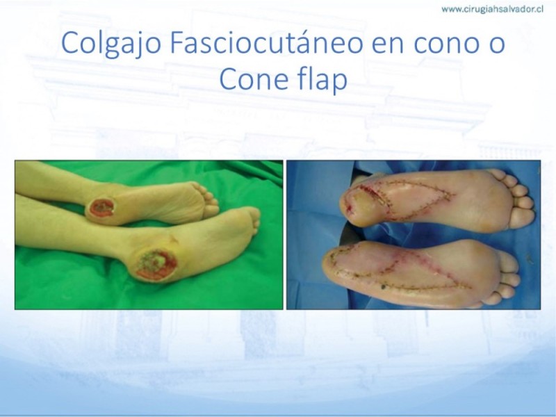 Diapositiva 59 de Cobertura de Extremidades Inferiores