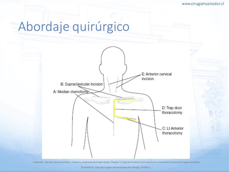 Diapositiva 24 de Anatomía quirúrgica y accesos quirúrgicos carotideo y subclavio