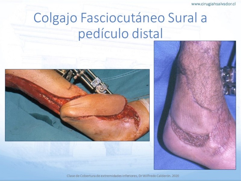 Diapositiva 47 de Cobertura de Extremidades Inferiores