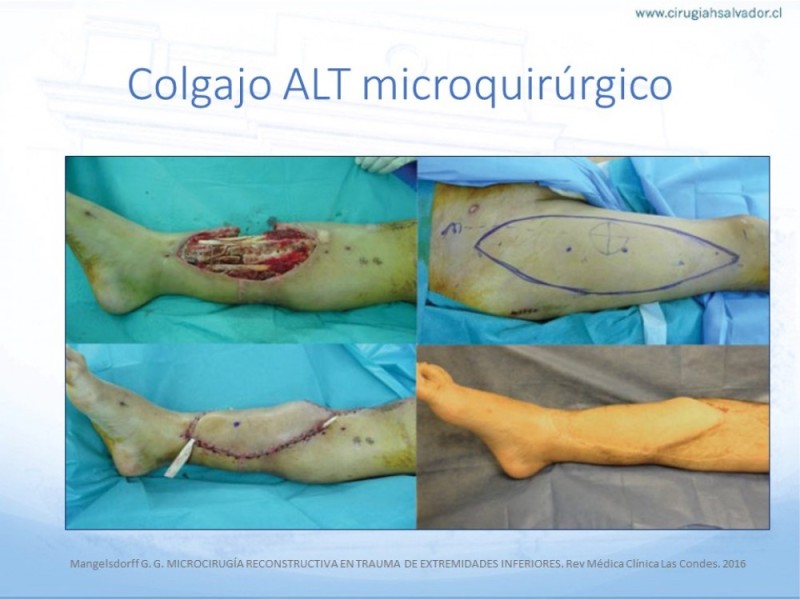 Diapositiva 41 de Cobertura de Extremidades Inferiores