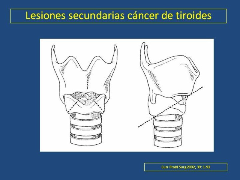 Diapositiva 32 de Estenosis laringo-traqueal pt. II