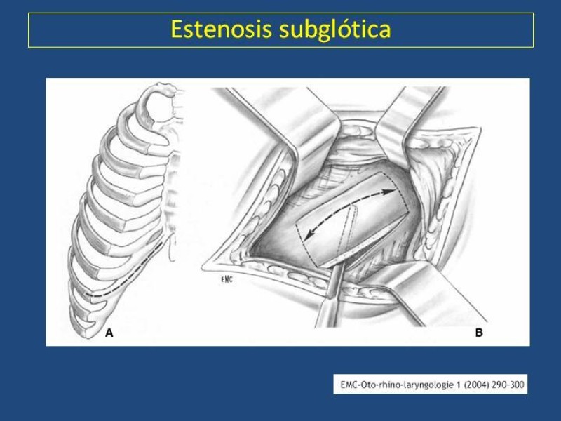 Diapositiva 15 de Estenosis laringo-traqueal pt. II