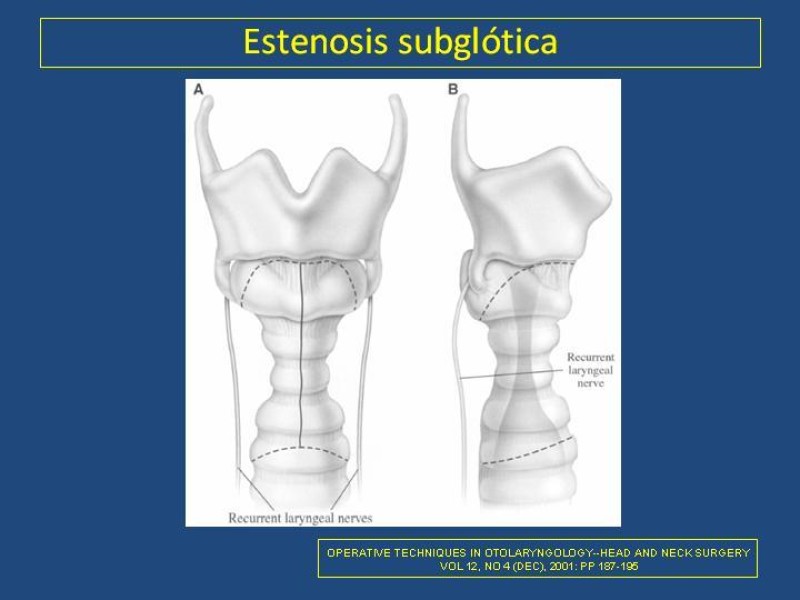 Diapositiva 18 de Estenosis laringo-traqueal pt. II