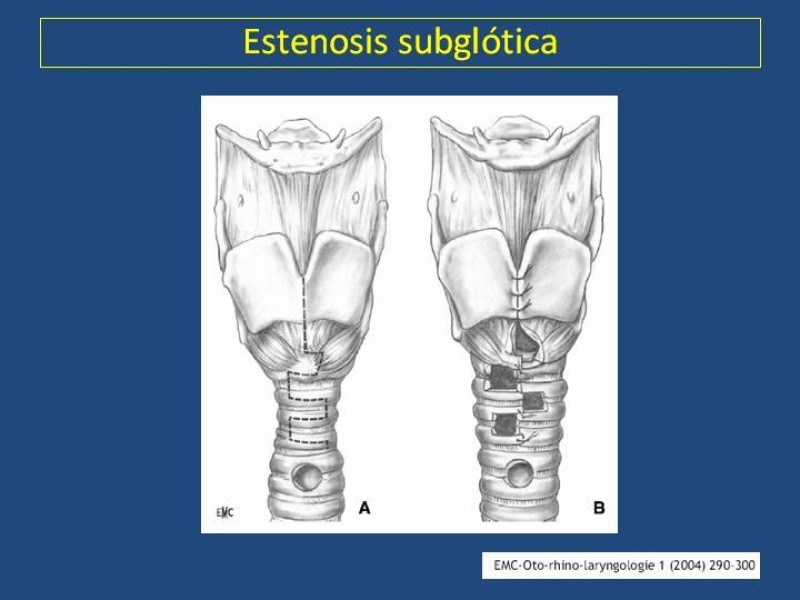 Diapositiva 23 de Estenosis laringo-traqueal pt. II