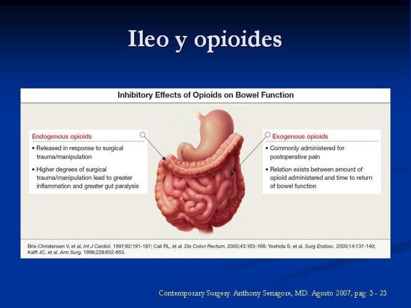 Diapositiva 18 de Ileo postoperatorio