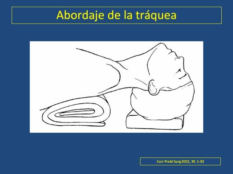 Diapositiva 38 de Estenosis laringo-traqueal pt. I